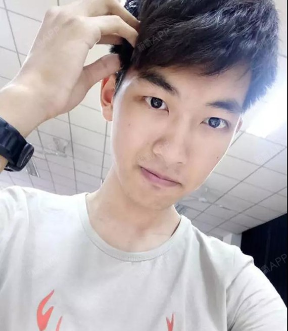 男生双眼皮开眼角,当初我为了美,就咬牙牙做了