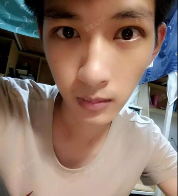 男生双眼皮开眼角,当初我为了美,就咬牙牙做了