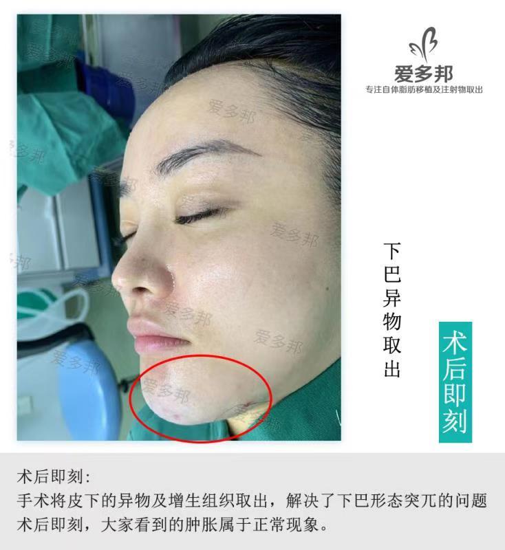 由于注射奥美定,这位女士的下巴增生变形,凹凸不平,这些问题给
