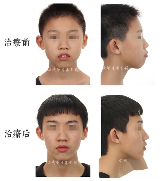 一是闭嘴时由于牙齿前突程度变化造成的软组织形态变化,包括嘴唇,人中