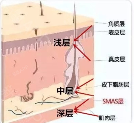 因此骨膜层提升是埋线除皱中最关键的提升层次,术后提升主要是起到