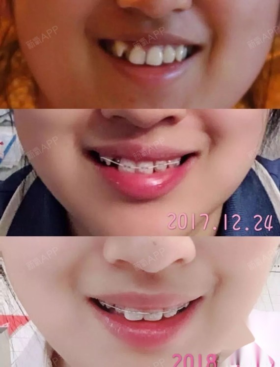 去年年底带牙套,正畸半年牙齿和脸型变化