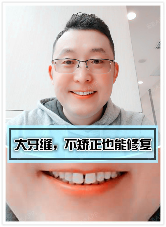 不用矫正快速修复门牙牙缝是怎么做到的?