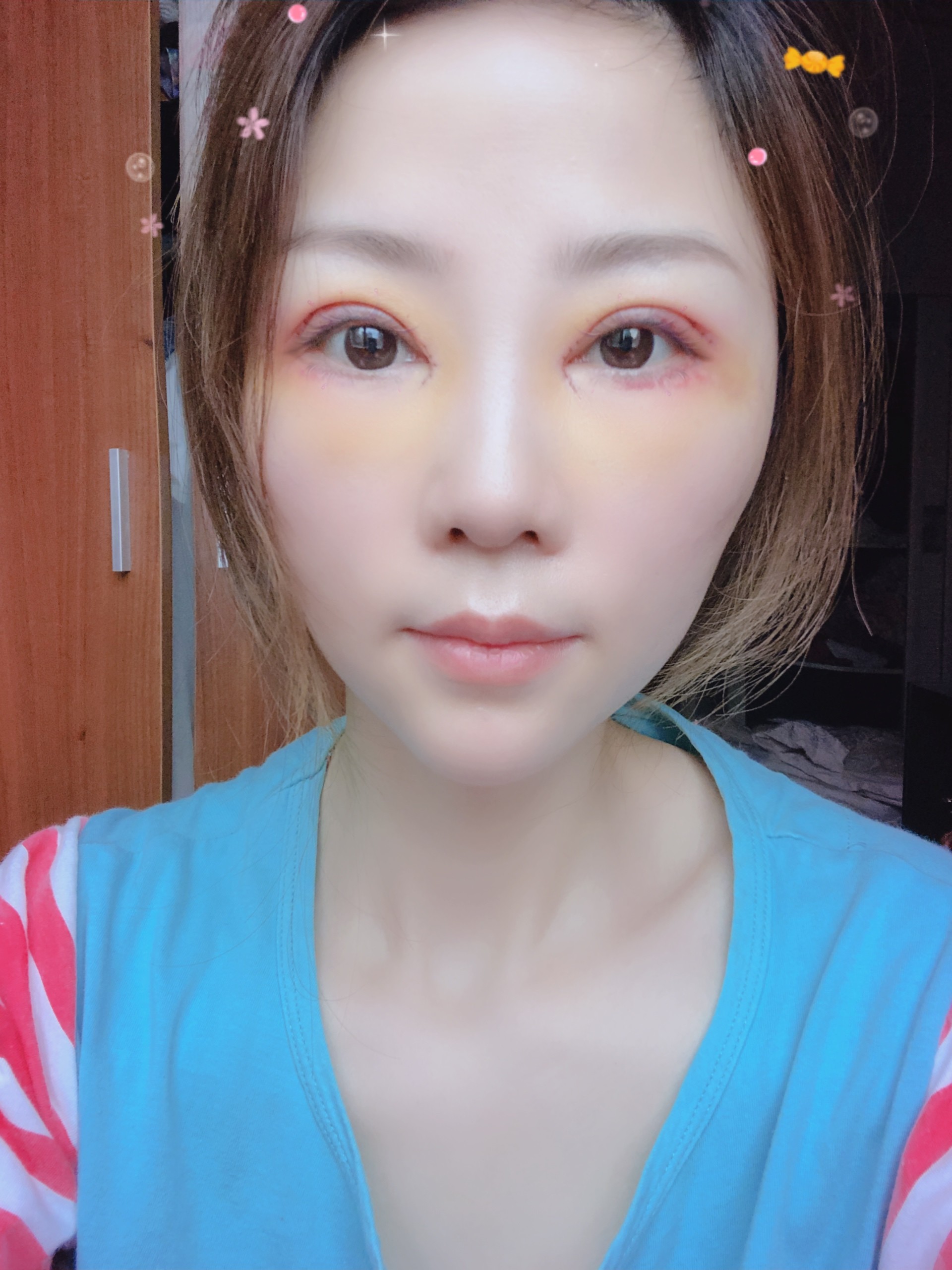 医生还是很了解我想做什么形状双眼皮,手术过程大概一个多小时,出来冰