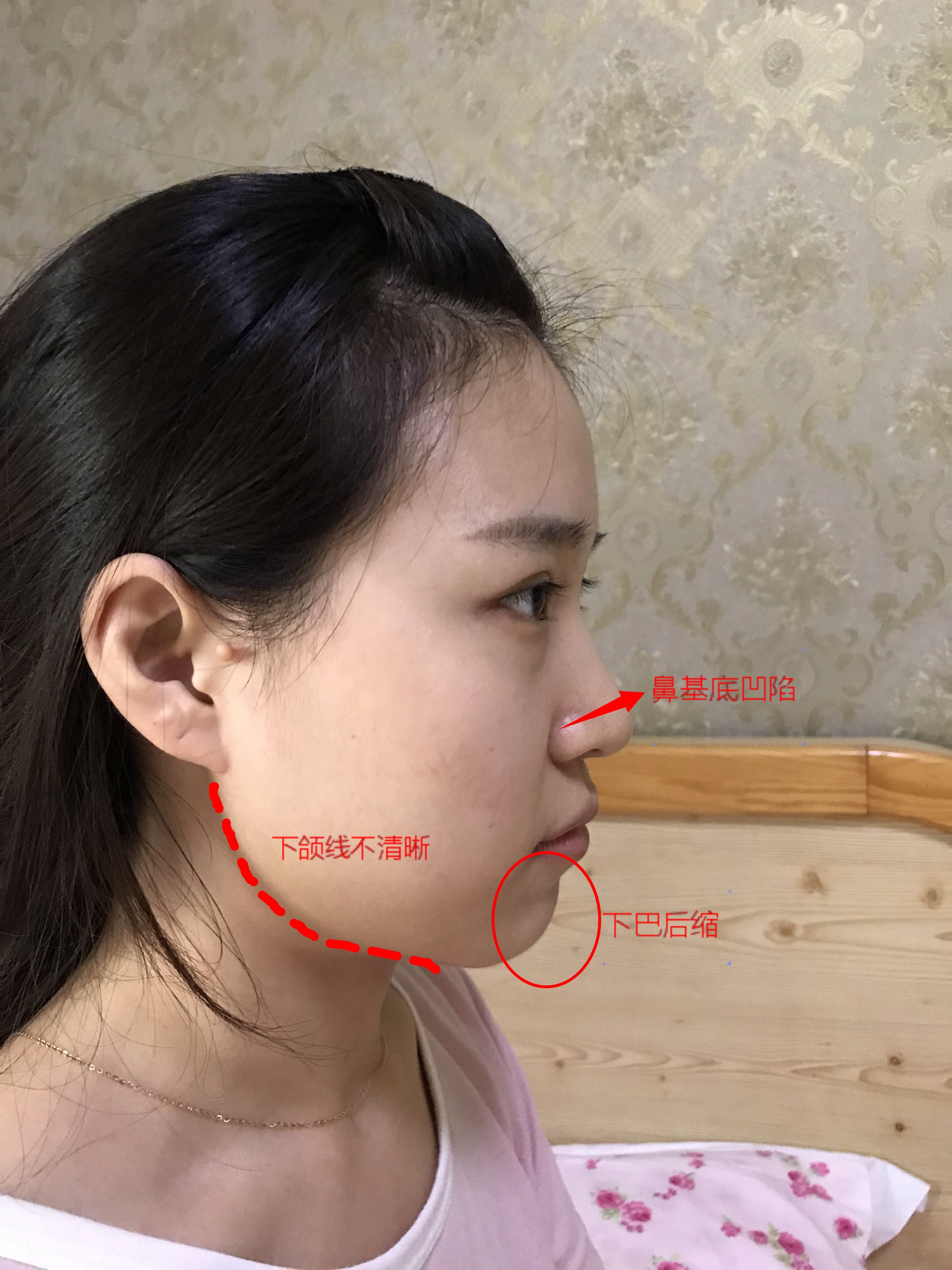 张侧面图来看,你的脸部主要有以下几个问题: ①鼻基底凹陷 ②下巴后缩