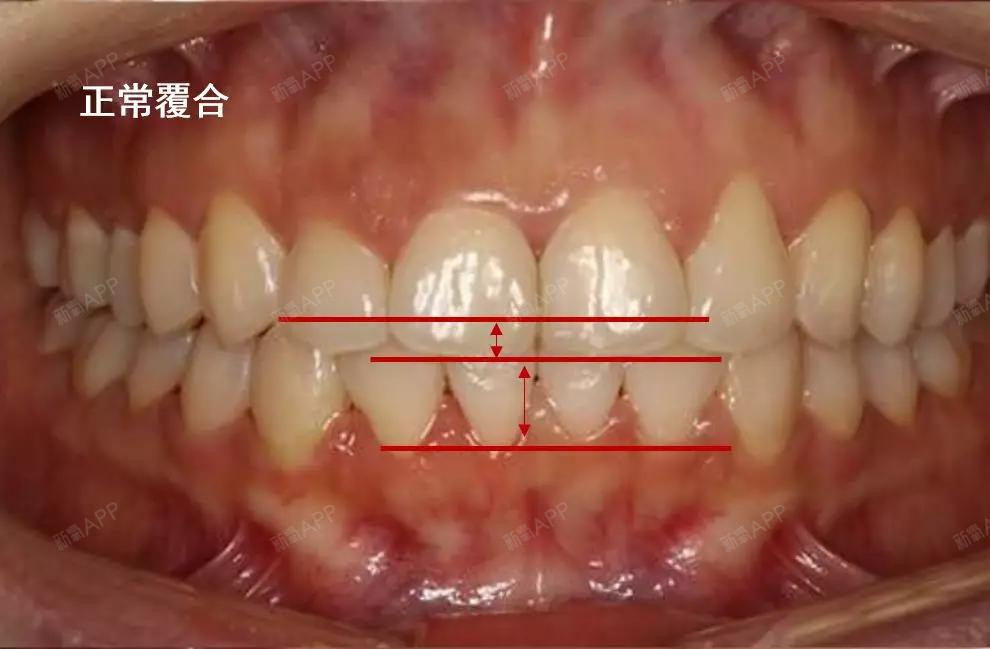 深覆合 正常的牙齿咬合,是上前牙盖过下前牙的距离不超过下前牙