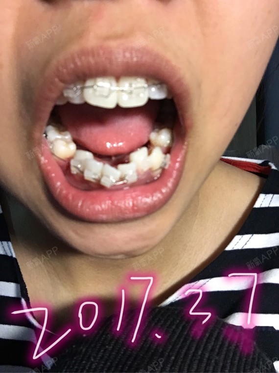 牙齿矫正