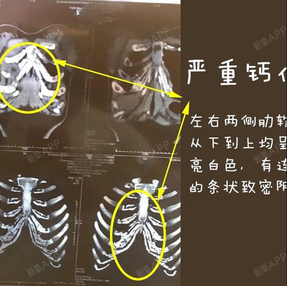 图一:"胜利手势"的肋软骨