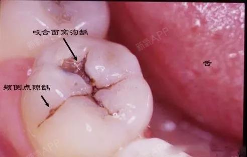 蛀牙为浅龋时,牙齿的表面有 一条黑线 沟壑内附着细菌,它们是导致
