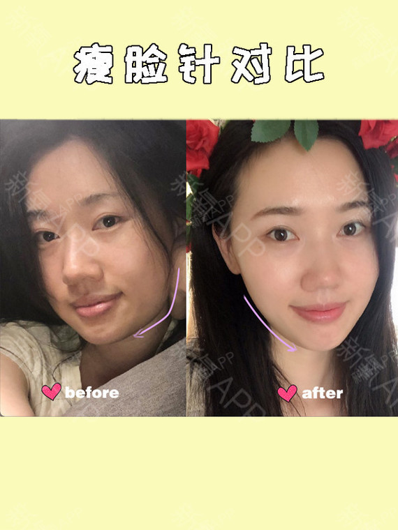 瘦脸针术后注意事项