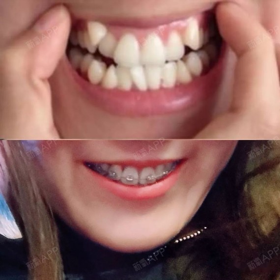 233天牙齿矫正,牙齿整齐了,虎牙消失了 第233天,对比图.