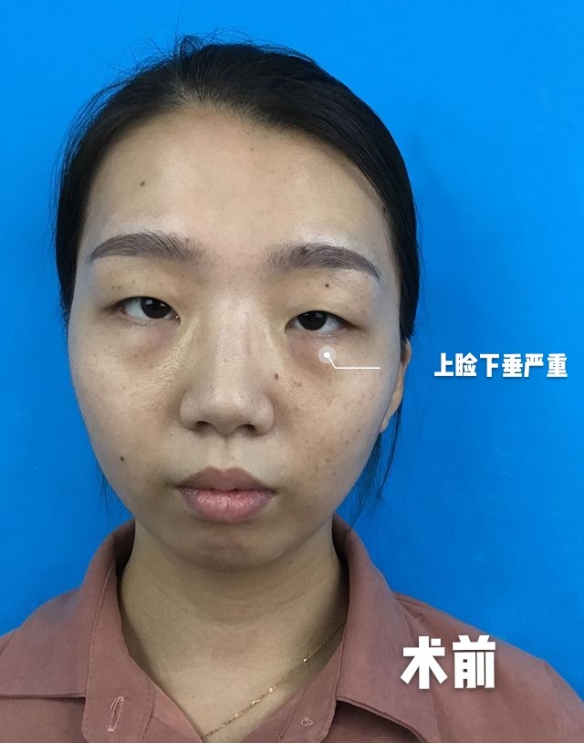 【涨点知识】什么是上睑下垂,应该如何改善?