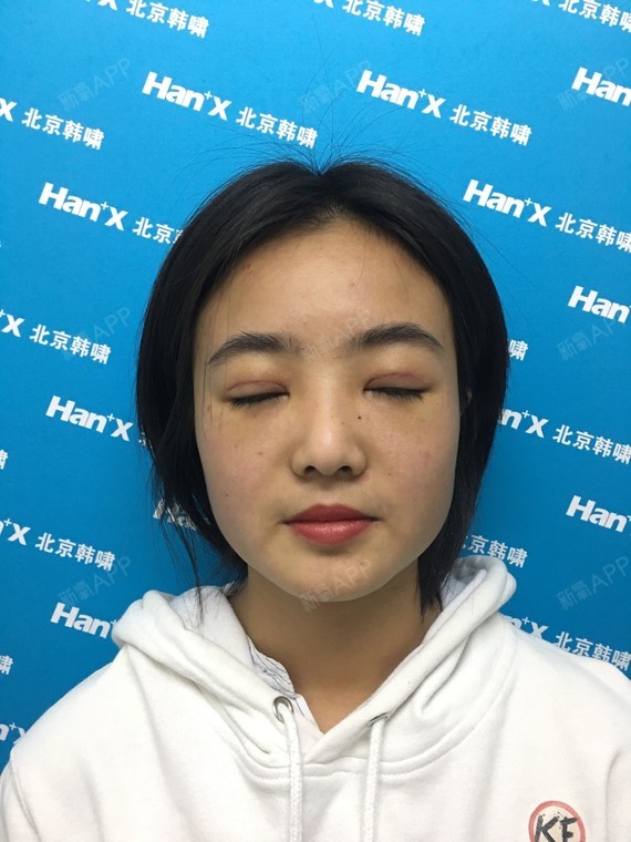 【北京韩啸双眼皮提肌无力矫正术】做完手术第一,二天_圈子-新氧美容