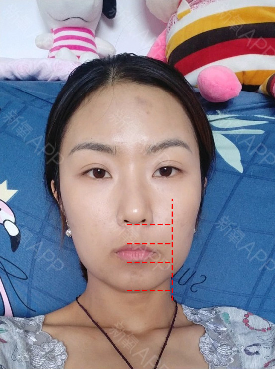 正面照来看,面部除了明显的下颌角问题,还存在人中过长,下巴短等问题