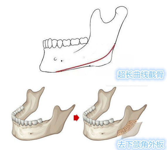 下颌角长曲线截骨有什么优缺点呢?