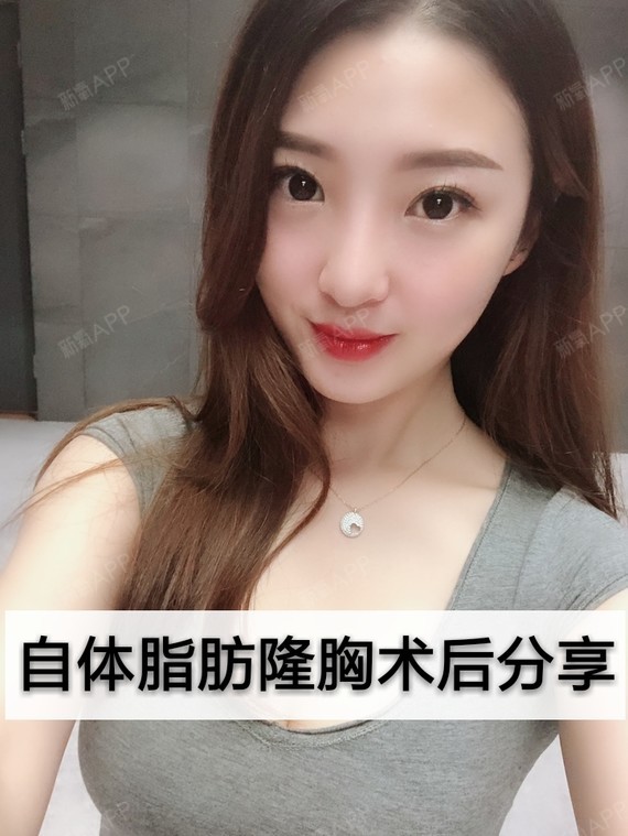 自体脂肪隆胸术后分享,超自然的胸部!