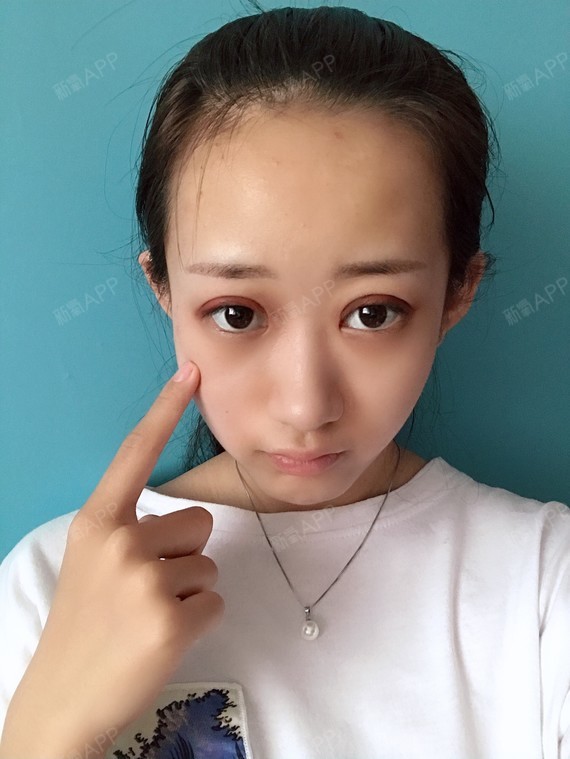 05双眼皮术后留疤71这个锅疤痕体质不背7575