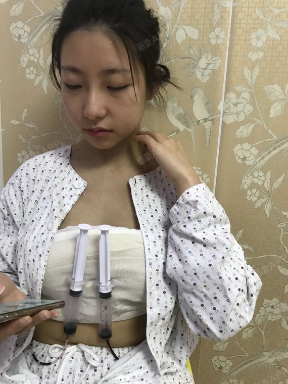 自体脂肪隆胸,让我成为完美女人!
