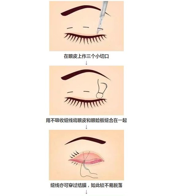 情况 【切开法双眼皮】 切开式重睑术又分定点切开双眼皮和全切双眼皮
