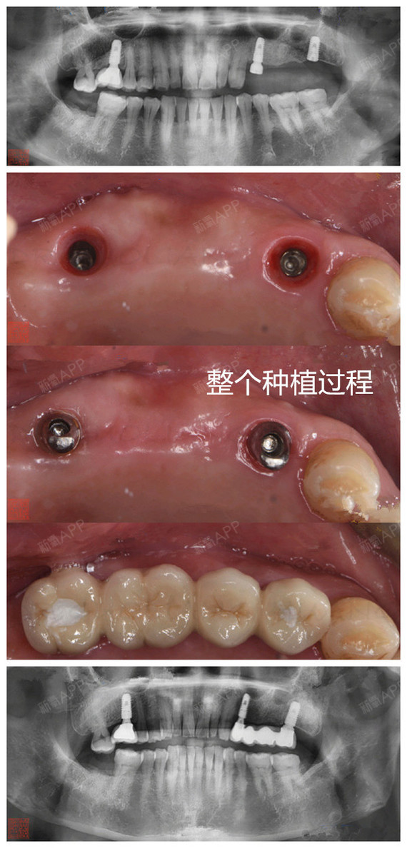 缺牙可能让你比别人老,种植牙可媲美真牙