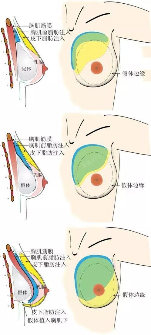 在临床上,我们可以采用双平面假体植入复合自体脂肪的方式,来解决组织