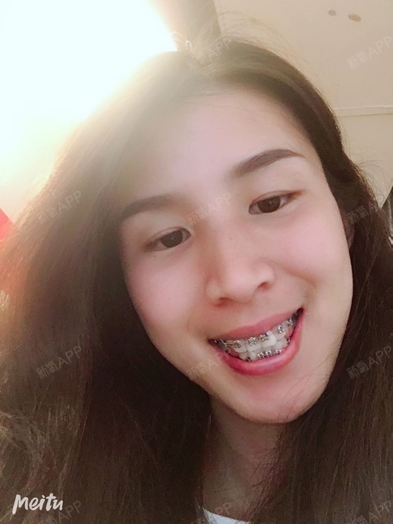 矫正前 矫正中 29岁老阿姨的矫正牙齿之路 开始矫_圈子-新氧美容整形