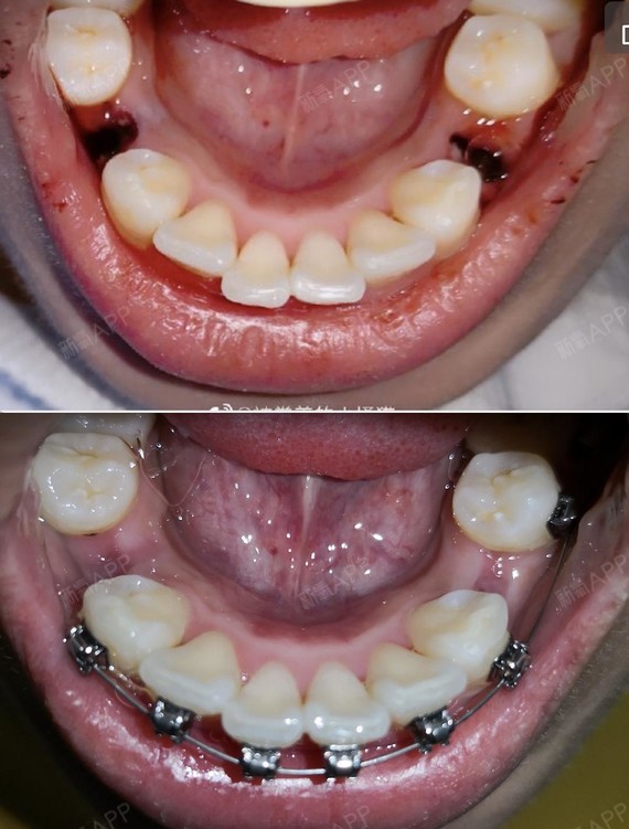 刚拔完牙和现在的对比 下门牙有一点点收回去了
