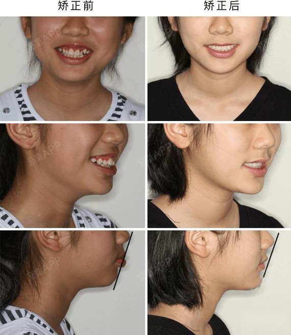 治疗前 小女孩初诊时13岁半,除了牙齿拥挤不齐外,门牙前突,虎牙突出