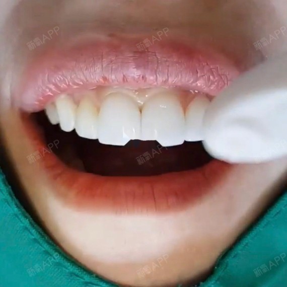 北京美牙#牙齿贴面也和烤瓷牙冠一样,是牙齿修复的