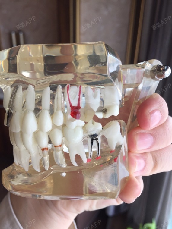 四张图告诉你一些口腔科常见治疗种植牙的植体呈钉子