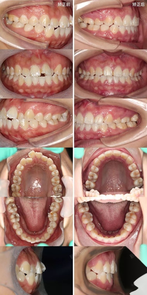 龅牙嘴凸没下巴,牙齿矫正对外貌的变化有多大?