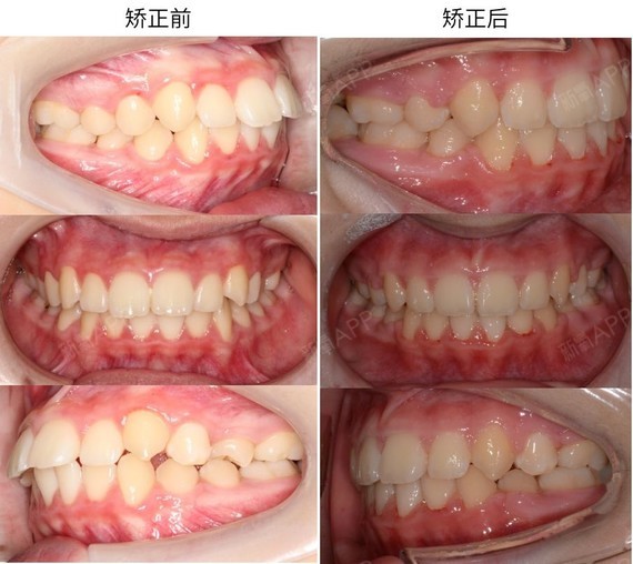 仅用了 15 个月,矫正后她的牙齿内收,上下唇外翻改善,侧面符合 e 线