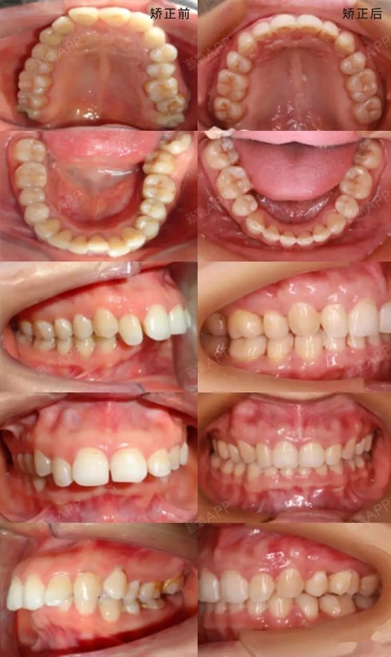 拔牙矫正.20个月,拔牙间隙显著变小,前突面型也得到了显著改善.
