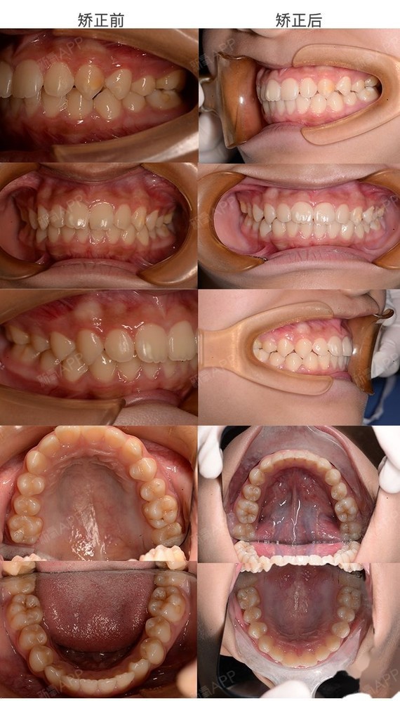 治疗前 这个小女孩的牙齿正面看起来相对整齐,但是只要看侧面,嘴凸的