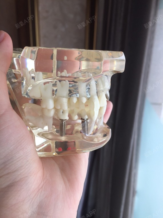 四张图告诉你一些口腔科常见治疗种植牙的植体呈钉子