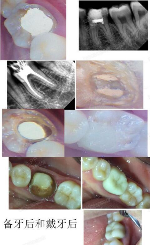 深圳世纪河山口腔真人案例#重新做根管治疗 树脂修复 烤瓷牙