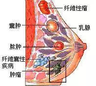 乳腺纤维瘤:乳腺纤维瘤的发病原因和乳腺增生差不多,还是雌激素搞的