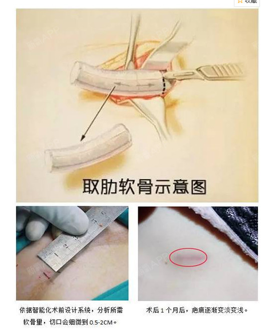 取肋软骨对身体伤害有多大?