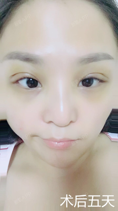 眼睛出现三眼皮究竟该怎么办?是否可以修复呢?