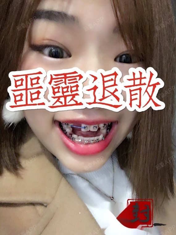 刚戴钢牙,拔了三颗牙齿.