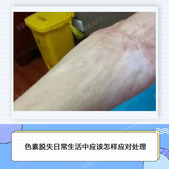 色素脱失疤痕是怎样形成的,日常生活饮食中应该如何应对处理?