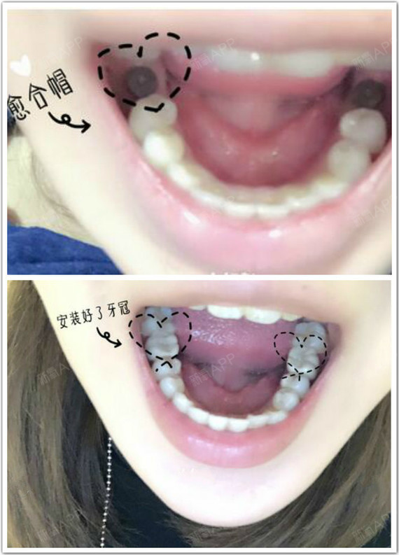 牙槽骨的外面包裹着牙龈组织,当牙齿周围组织因发炎没有得到很好的