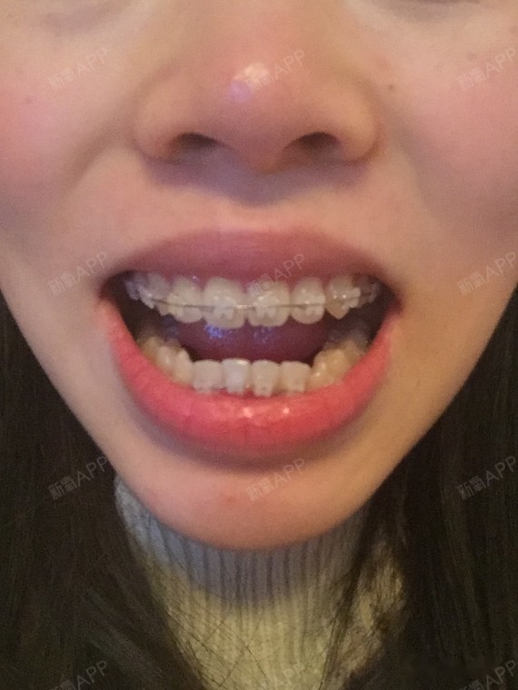 其实我一直牙齿都还算整齐