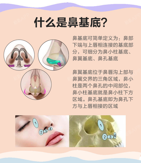 【假体垫鼻基底】骨膜层填充 大笑无感 鼻部黄金搭档 告别嘴凸/平复