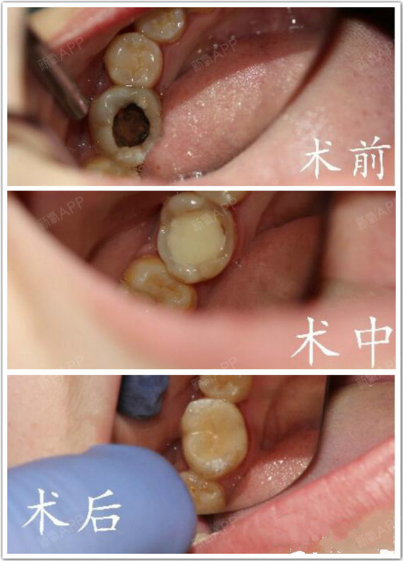 牙齿有点龋齿(蛀牙)不疼需要补吗