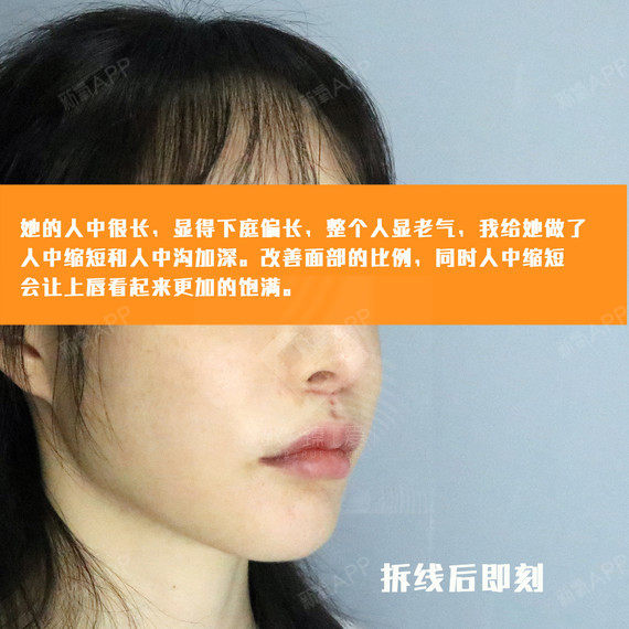 微笑唇 人中缩短 档案室原图案例对比