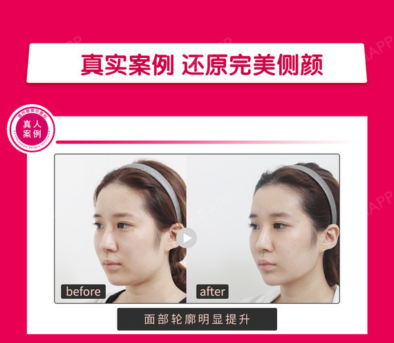 【除皱瘦脸】保妥适 除皱瘦脸 50单位 ,【下颌缘提升】多层次面部注射