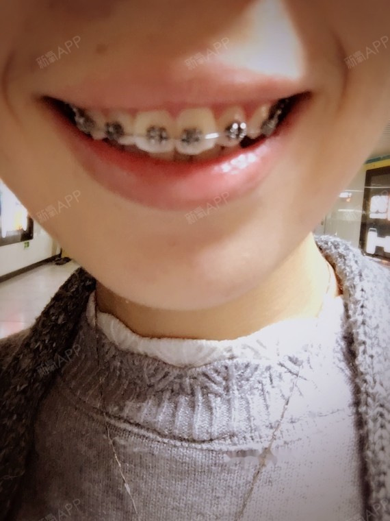 四眼钢牙妹,真真的是占全了!