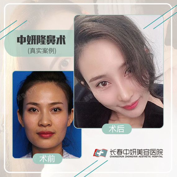 隆鼻中硅胶和膨体的优点和缺点有哪些?97硅胶假体