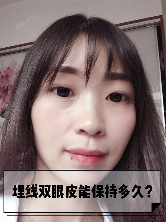 埋线双眼皮能保持多久?